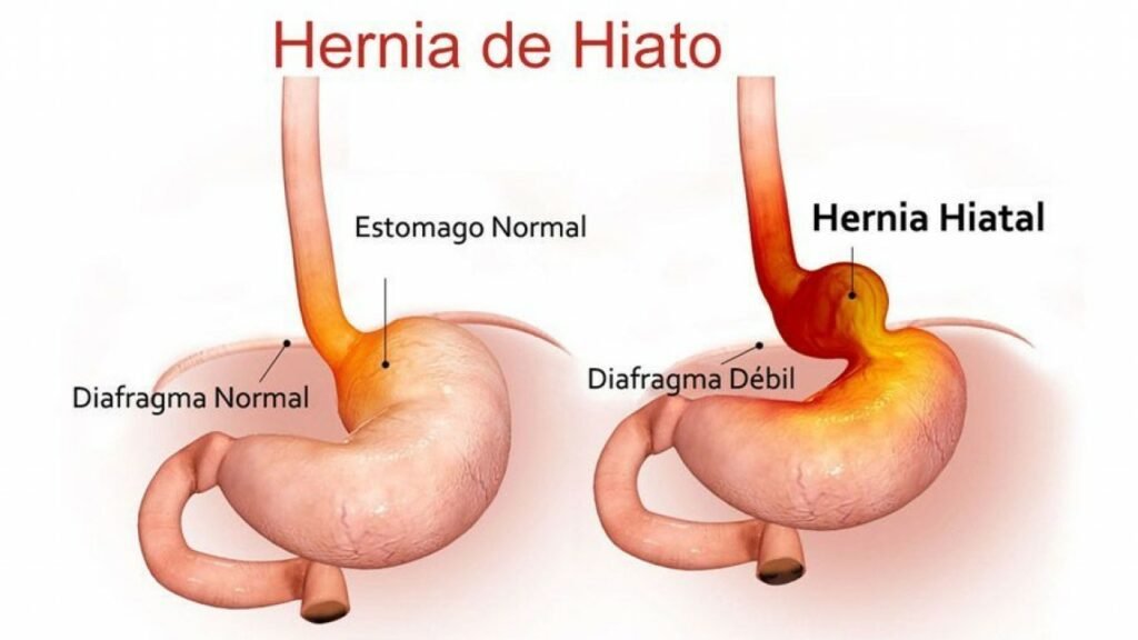 Hernia De Hiato Alimentos Prohibidos